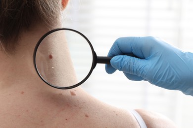 Photo of Doctor examining woman's moles in hospital, closeup