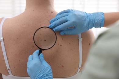 Photo of Doctor examining woman's moles in hospital, closeup