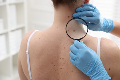 Photo of Doctor examining woman's moles in hospital, closeup