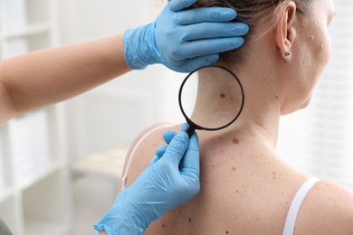 Photo of Doctor examining woman's moles in hospital, closeup