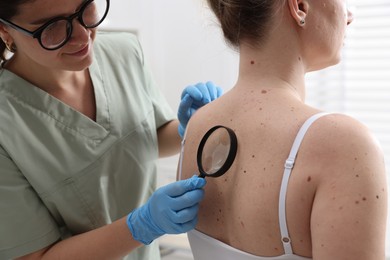 Photo of Doctor examining woman's moles in hospital, closeup
