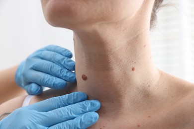 Photo of Doctor examining woman's moles in hospital, closeup
