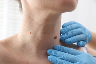Photo of Doctor examining woman's moles in hospital, closeup