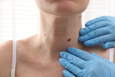 Photo of Doctor examining woman's moles in hospital, closeup