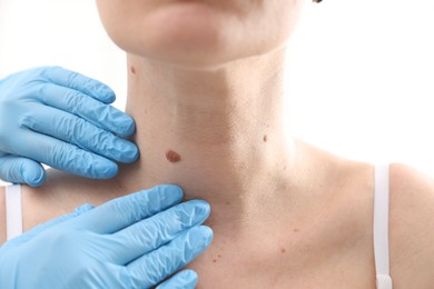 Photo of Doctor examining woman's moles in hospital, closeup