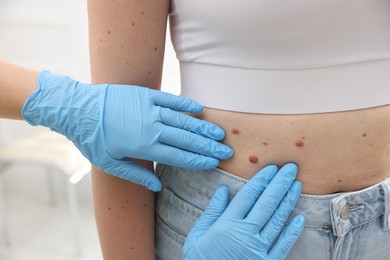 Photo of Doctor examining woman's moles in hospital, closeup