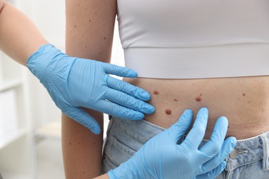 Photo of Doctor examining woman's moles in hospital, closeup