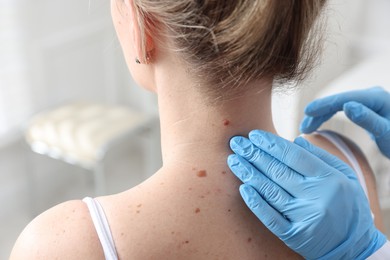 Photo of Doctor examining woman's moles in hospital, closeup