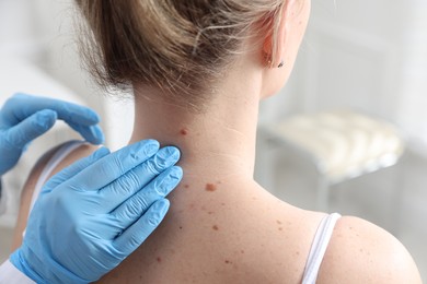 Photo of Doctor examining woman's moles in hospital, closeup