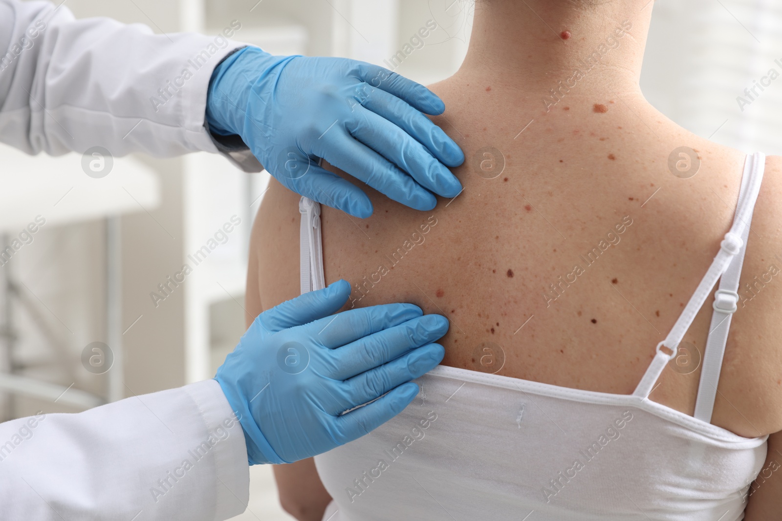 Photo of Doctor examining woman's moles in hospital, closeup