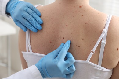 Photo of Doctor examining woman's moles in hospital, closeup