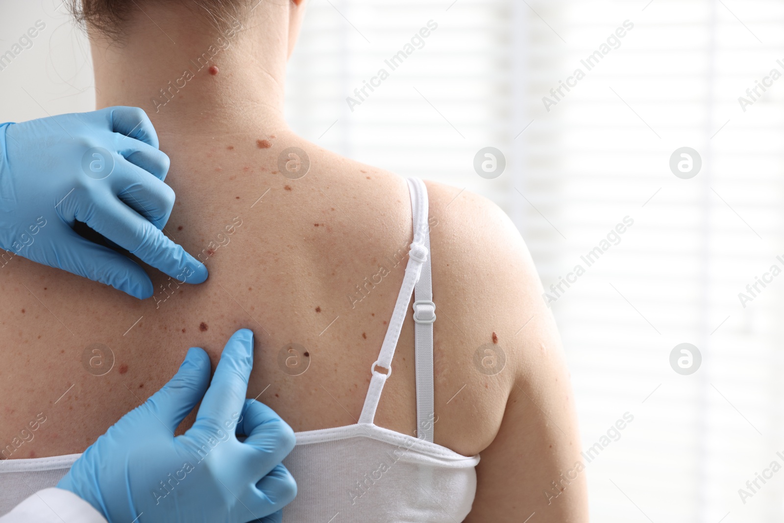 Photo of Doctor examining woman's moles in hospital, closeup. Space for text