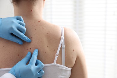Photo of Doctor examining woman's moles in hospital, closeup. Space for text