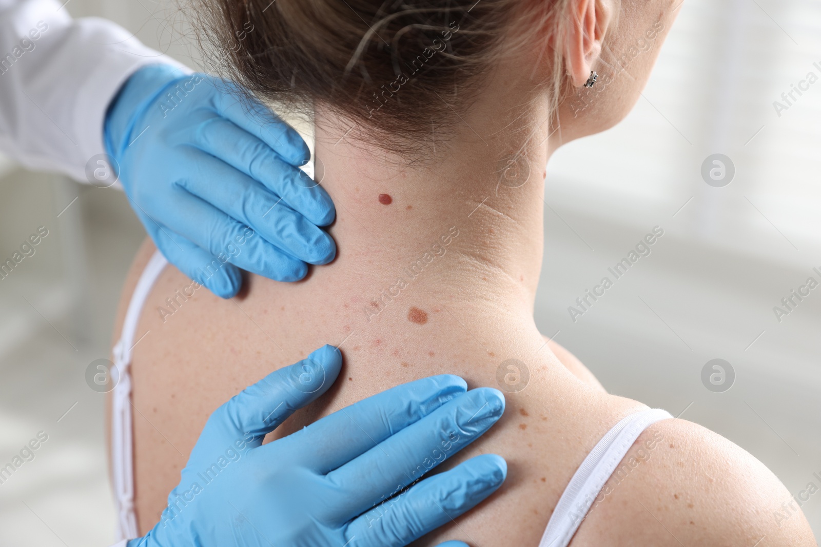 Photo of Doctor examining woman's moles in hospital, closeup