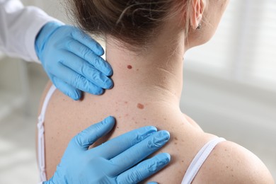 Photo of Doctor examining woman's moles in hospital, closeup