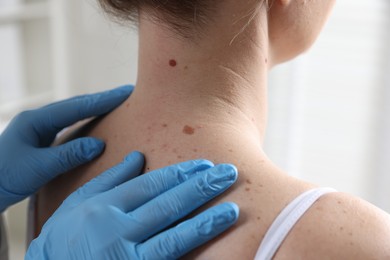 Photo of Doctor examining woman's moles in hospital, closeup