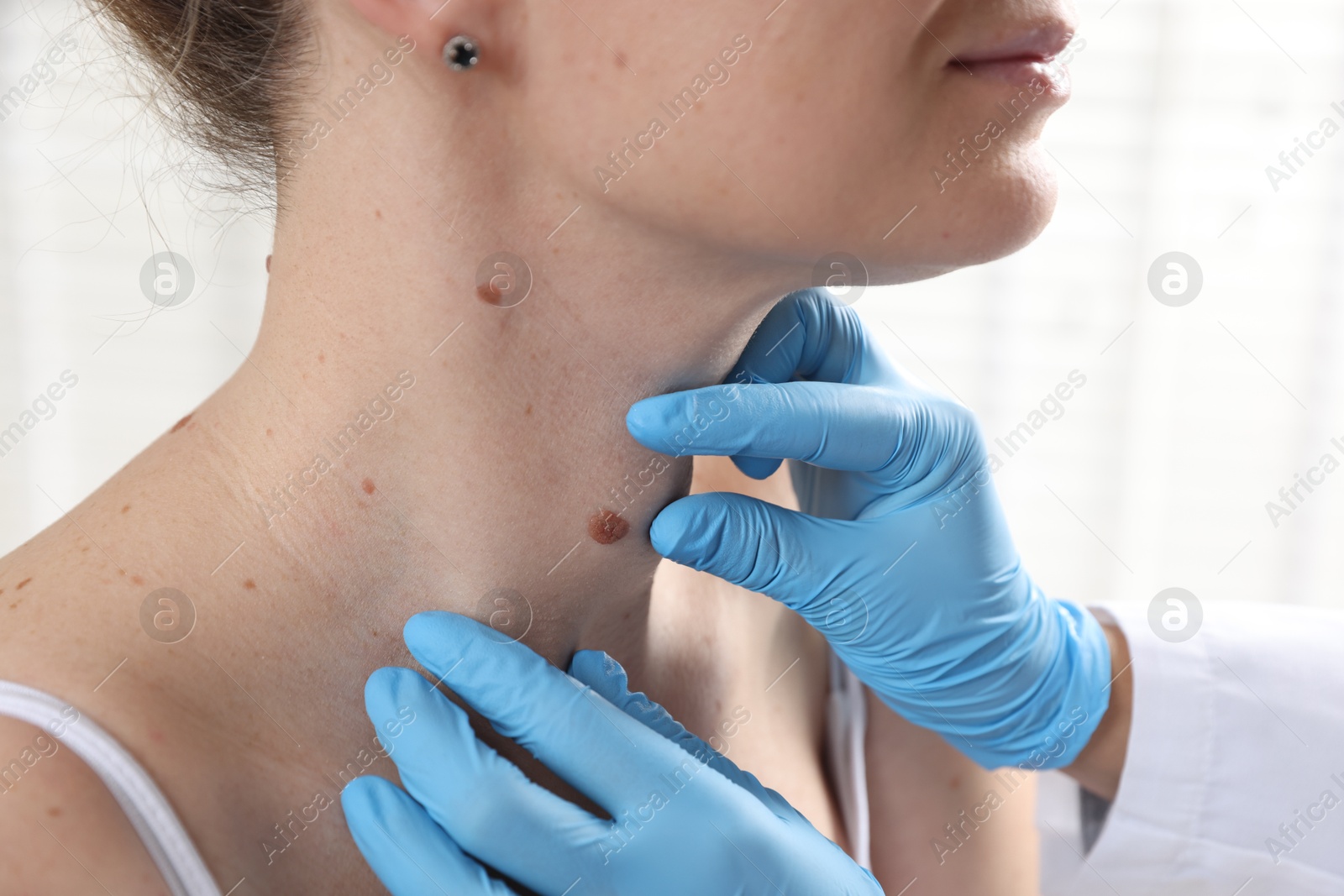 Doctor examining woman's moles in hospital, closeup Photo of Doctor examining woman's moles in hospital, closeup
