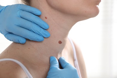 Photo of Doctor examining woman's moles in hospital, closeup