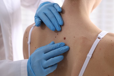 Photo of Doctor examining woman's moles in hospital, closeup