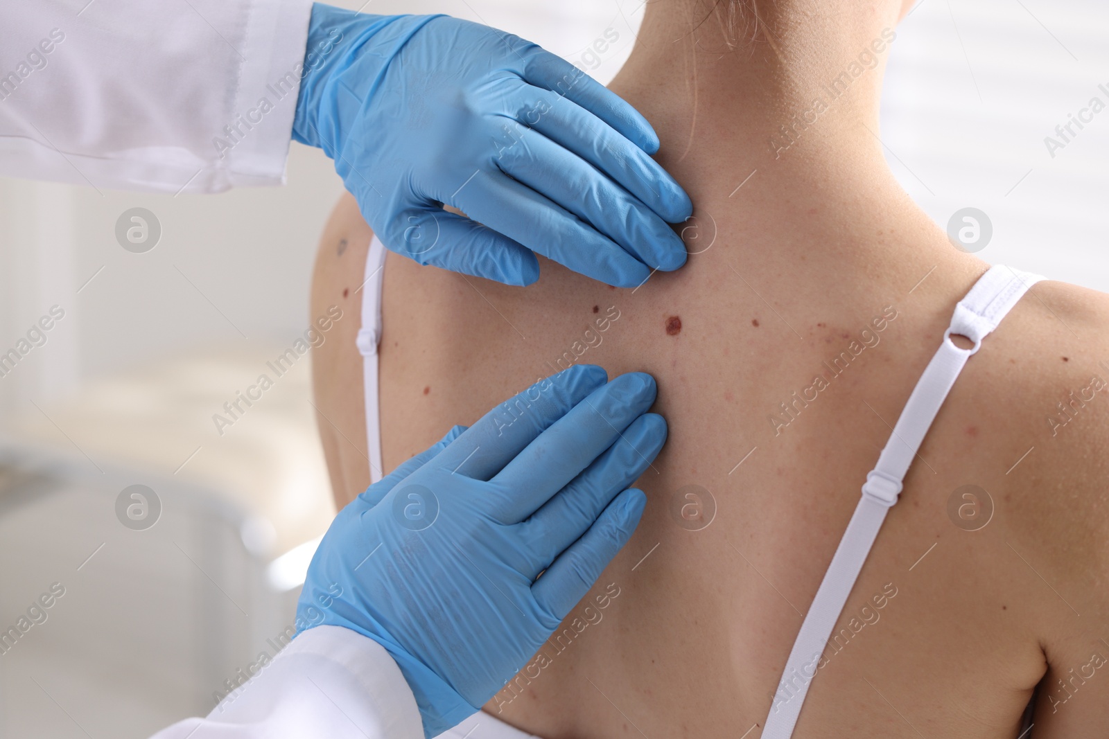 Photo of Doctor examining woman's moles in hospital, closeup