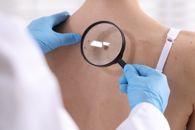 Photo of Doctor examining woman's moles in hospital, closeup
