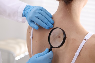 Photo of Doctor examining woman's moles in hospital, closeup