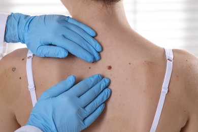 Photo of Doctor examining woman's moles in hospital, closeup