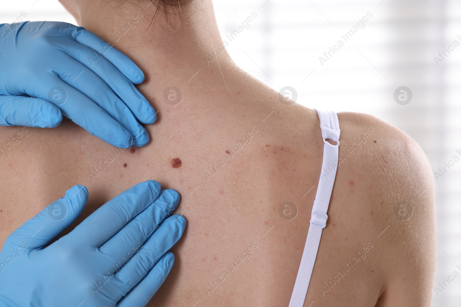 Doctor examining woman's moles in hospital, closeup Photo of Doctor examining woman's moles in hospital, closeup