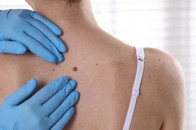 Photo of Doctor examining woman's moles in hospital, closeup