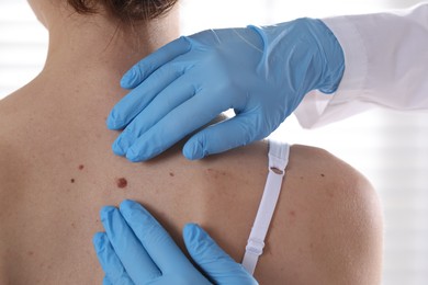Photo of Doctor examining woman's moles in hospital, closeup