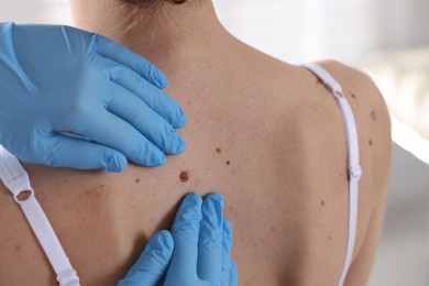 Photo of Doctor examining woman's moles in hospital, closeup