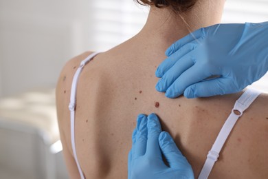 Photo of Doctor examining woman's moles in hospital, closeup