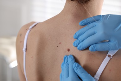 Photo of Doctor examining woman's moles in hospital, closeup