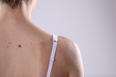 Photo of Woman with moles on her body against light background, closeup. Space for text