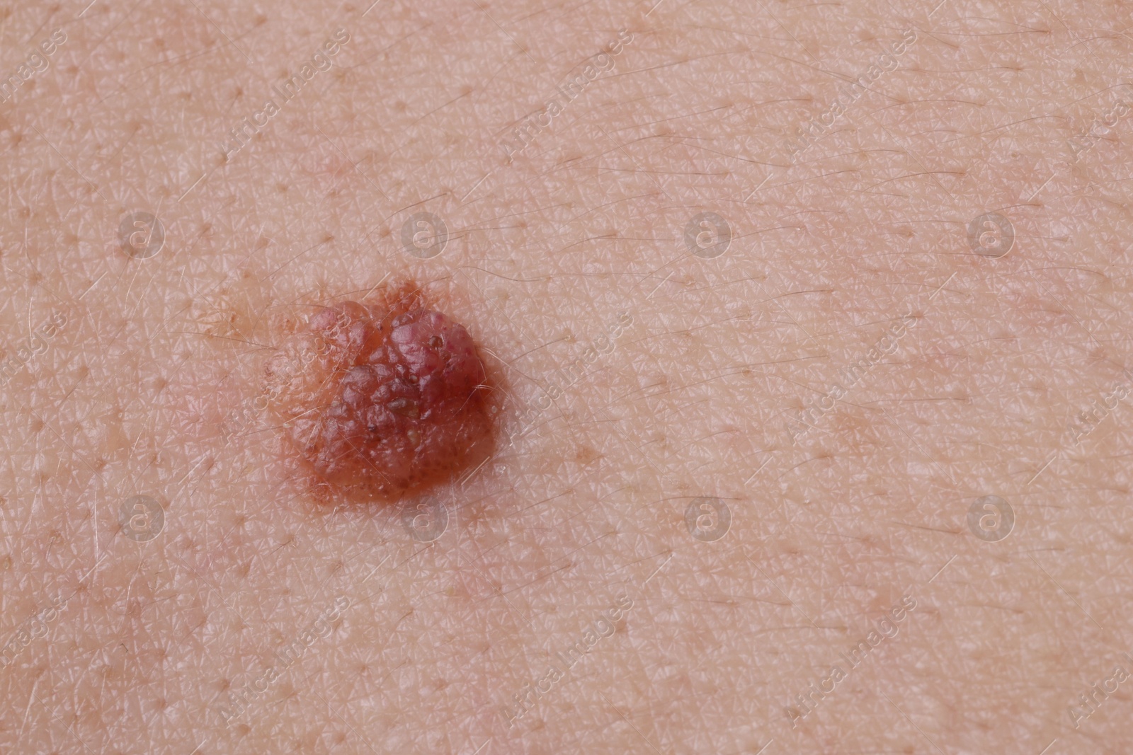 Photo of Woman with mole on her body, closeup