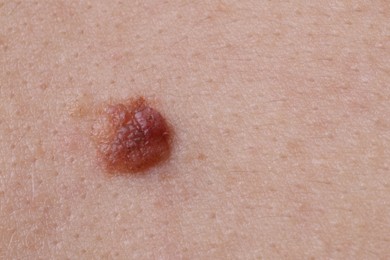 Photo of Woman with mole on her body, closeup