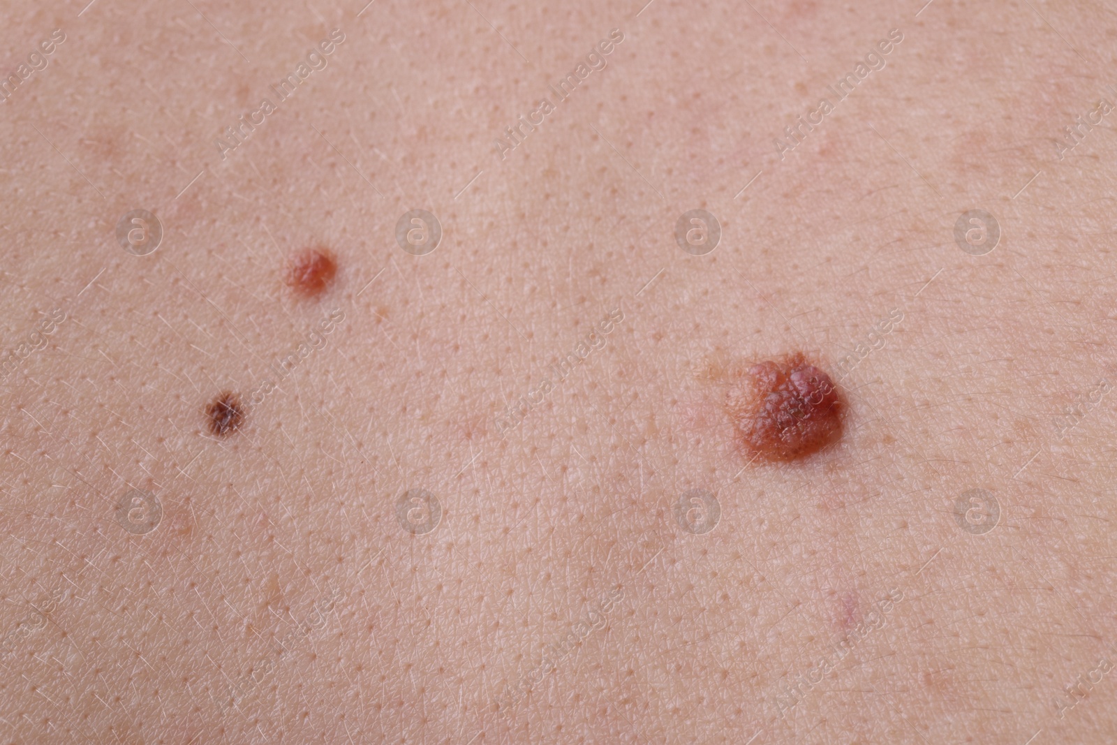 Woman with moles on her body, closeup Photo of Woman with moles on her body, closeup