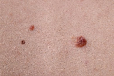 Photo of Woman with moles on her body, closeup
