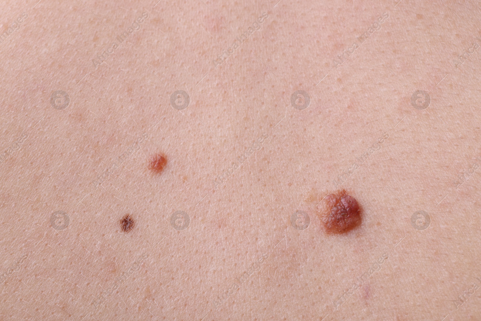 Photo of Woman with moles on her body, closeup