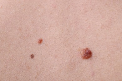 Photo of Woman with moles on her body, closeup