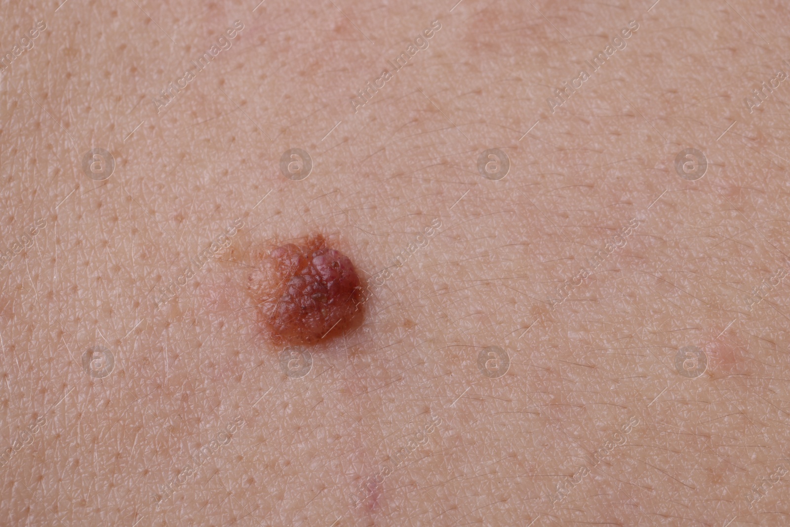 Photo of Woman with mole on her body, closeup