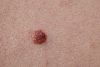 Photo of Woman with mole on her body, closeup