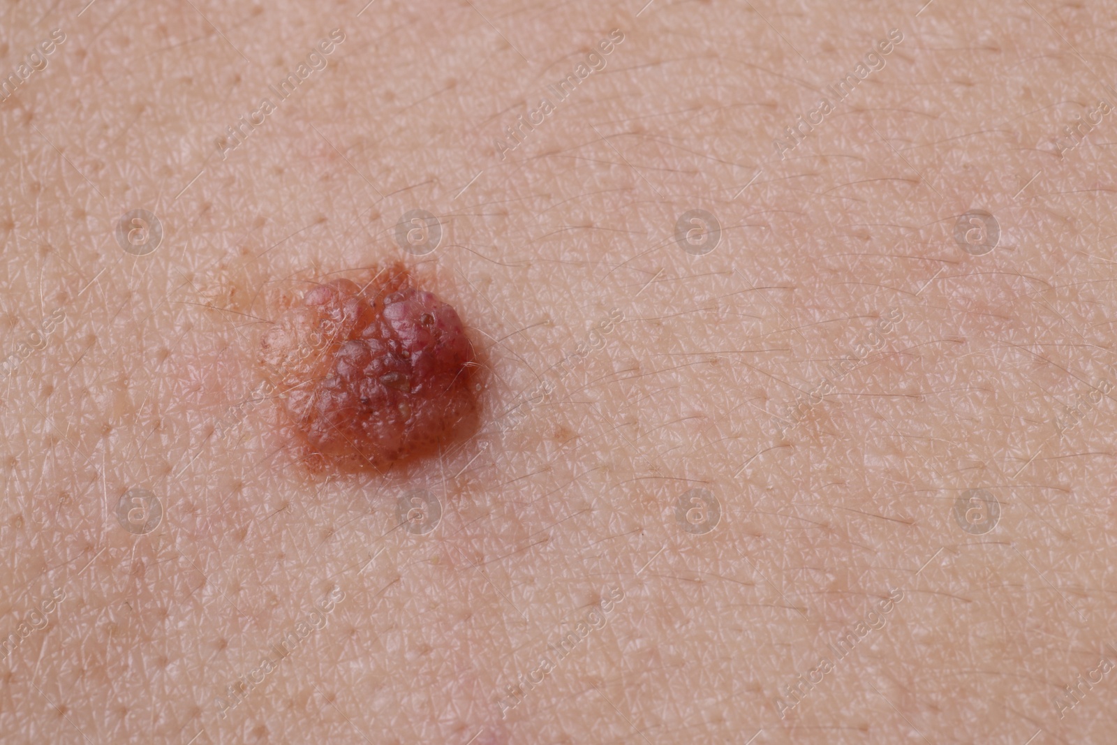 Woman with mole on her body, closeup Photo of Woman with mole on her body, closeup