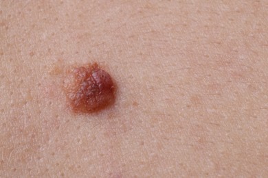 Photo of Woman with mole on her body, closeup