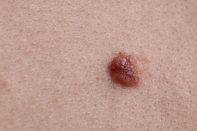 Photo of Woman with mole on her body, closeup