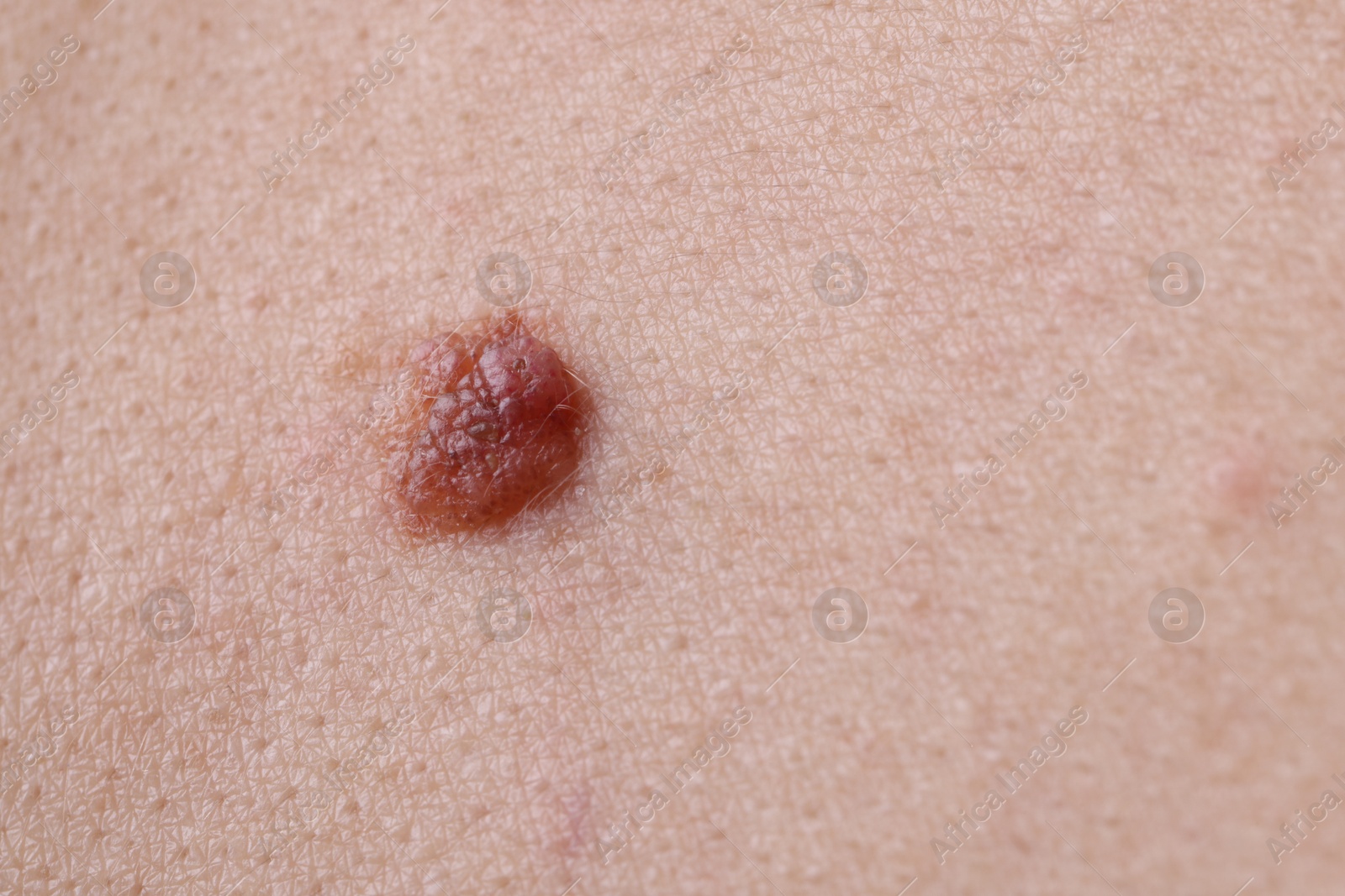 Photo of Woman with mole on her body, closeup