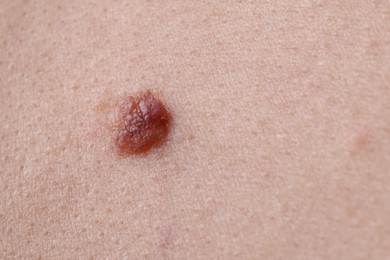 Photo of Woman with mole on her body, closeup