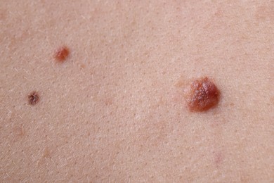 Photo of Woman with moles on her body, closeup