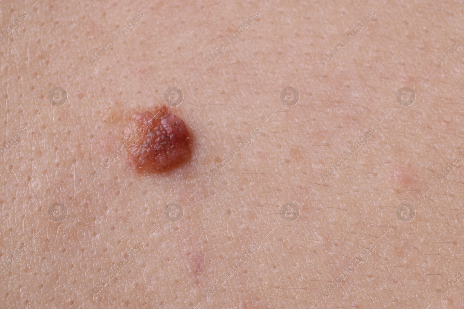 Photo of Woman with mole on her body, closeup