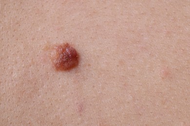 Photo of Woman with mole on her body, closeup